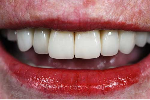Complex Rehabilitation of Upper Teeth with All Procelain Crowns