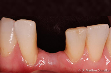 Dental Implants Treatment - 5