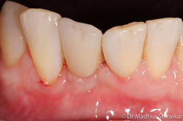 Rebuilding the Worn Down Teeth with Premium Crowns