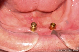 Dental Implants Treatment - 3