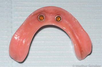 Dental Implants Treatment - 4