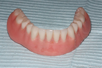 Dental Implant Dentures