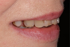 Teeth Health