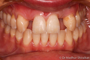 Dental Implants Treatment - 2