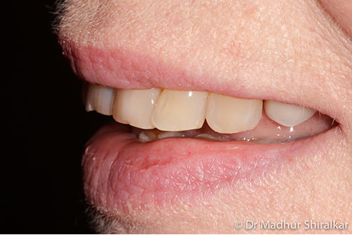 Rebuilding and Cosmetic improvement of the Worn Smile