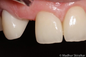 Teeth Replacement Treatment - 2