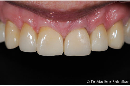 Restoring Significantly Worn Upper Teeth with Procelain Crowns and Implants