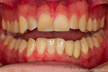 No Gap Dental Implants