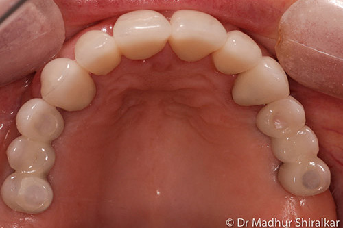 MaryO-05-Complex Reconstruction for Worn and Missing Teeth