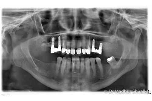Complex Reconstruction for Worn and Missing Teeth
