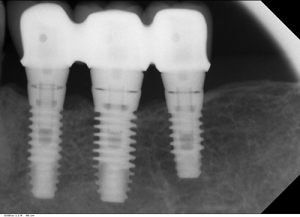 Complex oral Rehabilatation crown bridges and fooooour Implants