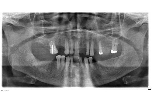 Complex oral Rehabilatation crown bridges and fooooour Implants