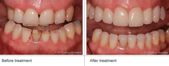 Before-After Treatment