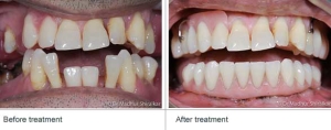 Missing Teeth Before After