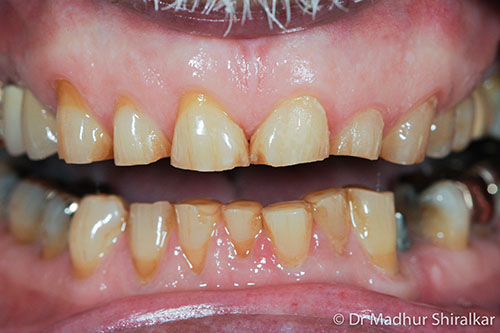 Rebuilding the Worn Down Teeth with Premium Crowns