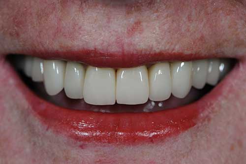 Complex Rehabilitation of Upper Teeth with All Procelain Crowns