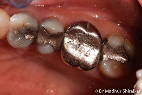 Enhancing Worn and Compromised Teeth with Procelain Veeners and Crowns