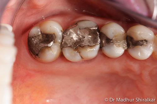 Enhancing Worn and Compromised Teeth with Procelain Veeners and Crowns