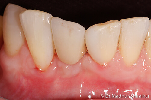 Lower Single Tooth Replacement in a Narrow Space