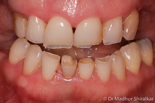 MaryO-02-Complex Reconstruction for Worn and Missing Teeth