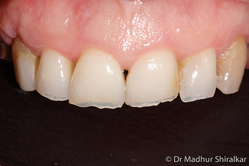MaryO-06-Complex Reconstruction for Worn and Missing Teeth