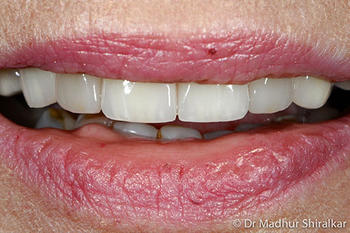 Rebuilding and Cosmetic improvement of the Worn Smile