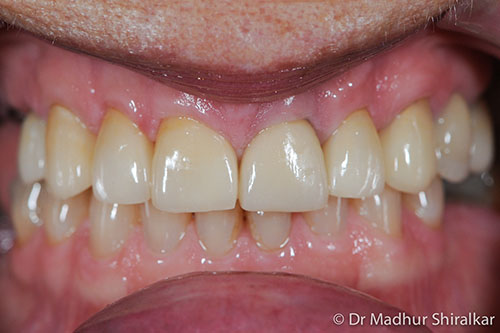 Restoring Significantly Worn Upper Teeth with Procelain Crowns and Implants