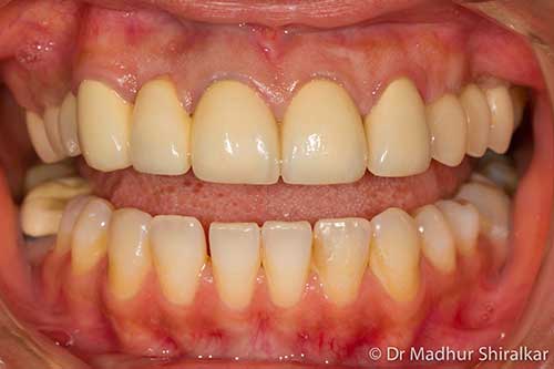 Bone Grafting and Implant Bridge for three teeth