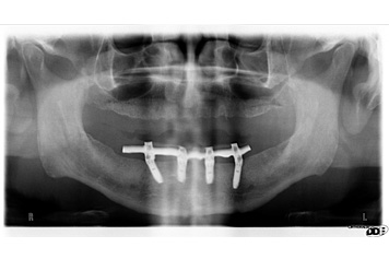 Dental Implants- 6