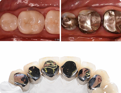 Amalgam Silver Mercury Filling Removal Amalgam Silver Mercury Filling Removal
